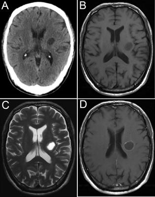 Case Report: Clinical and Procedural Implications of Ommaya Reservoir Implantation in Cystic Brain Metastases Followed by Radiosurgery Treatment